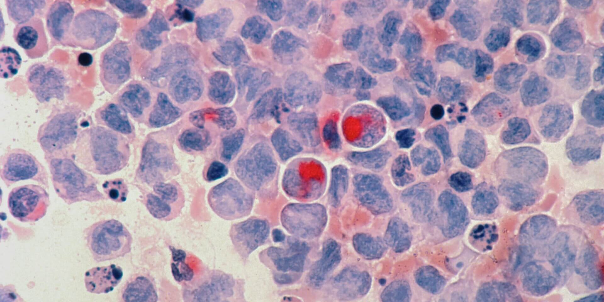 Acute myelocytic leukaemia (AML) under a microscope